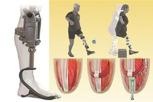 MIT Develops Novel 'Bionic Knee' Prosthesis